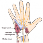 Carpal tunnel syndrome