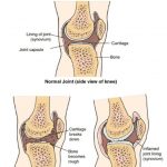 What is osteoarthritis?