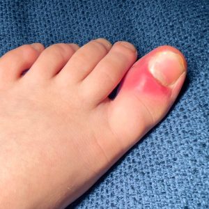 ingrown toenail - diabetes